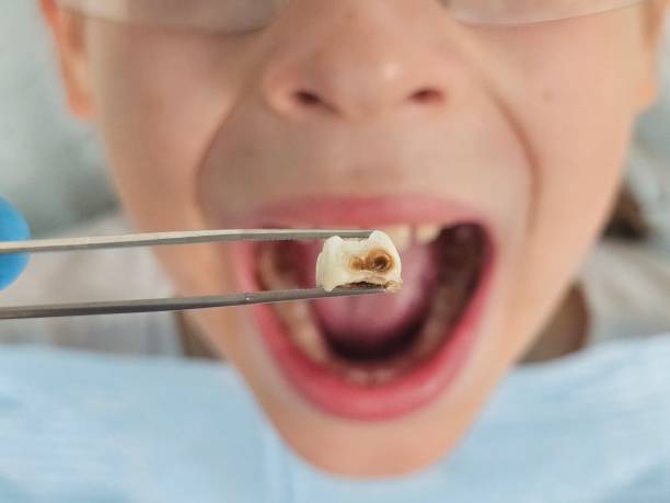 Best Emergency Dental Extractions in Riverside, CT